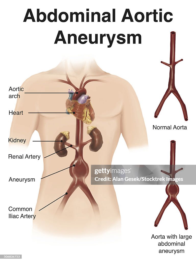 Artist depcition of abdominal aortic aneuryism (with labels).