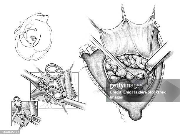 left frontotemporal craniotomy for posterior communicating artery aneurysm clipping. - scalp stock illustrations