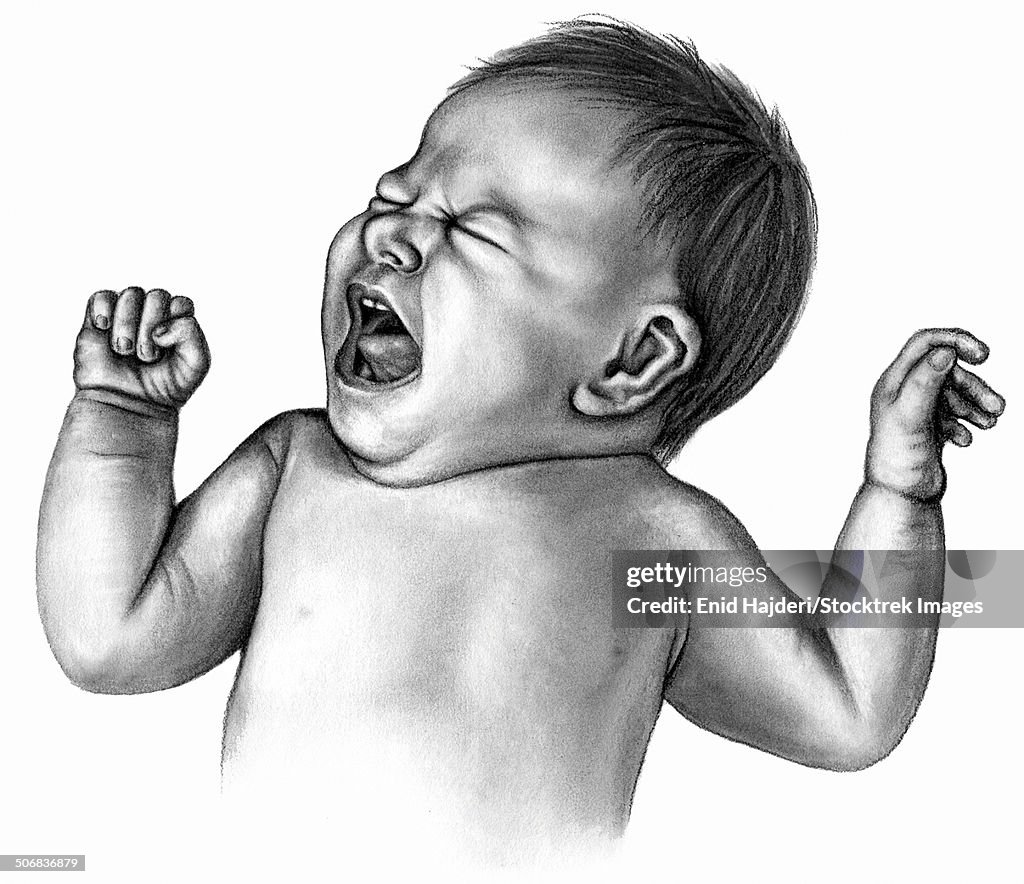 Persistent crying in infants may lead to cyanosis (blue baby).