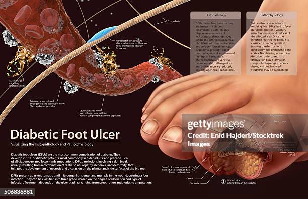 stockillustraties, clipart, cartoons en iconen met histopathology and pathophysiology of diabetic food ulcers. - macrophage