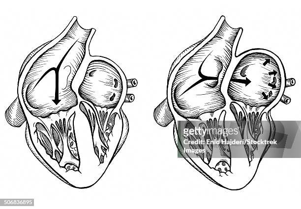 bildbanksillustrationer, clip art samt tecknat material och ikoner med comparison of normal heart versus heart with a patent foramen ovale. - heart ventricle
