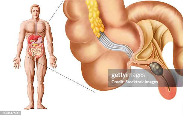 ilustrações de stock, clip art, desenhos animados e ícones de medical ilustration of an appendix with appendicitis. - appendicitis