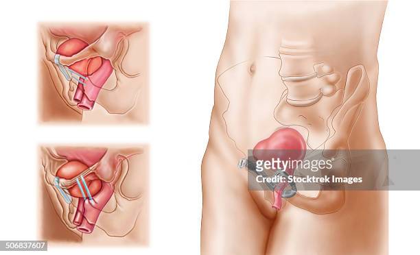 illustrations, cliparts, dessins animés et icônes de anatomy of bladder suspension procedure for urinary incontinence in females. - sphincter