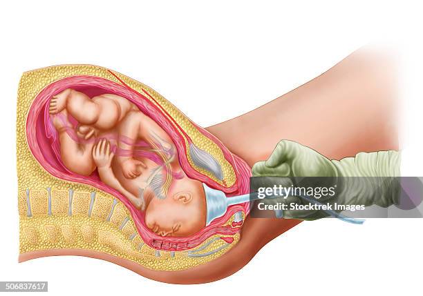 medical ilustration showing delivery of fetus using vacuum extraction due to shoulder dystocia. - schambeinfuge stock-grafiken, -clipart, -cartoons und -symbole