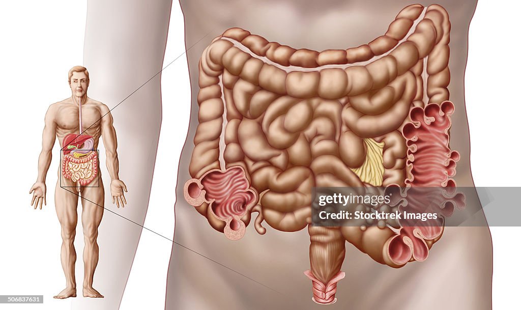 Diverticulitis in the descending colon region of the human intestine.