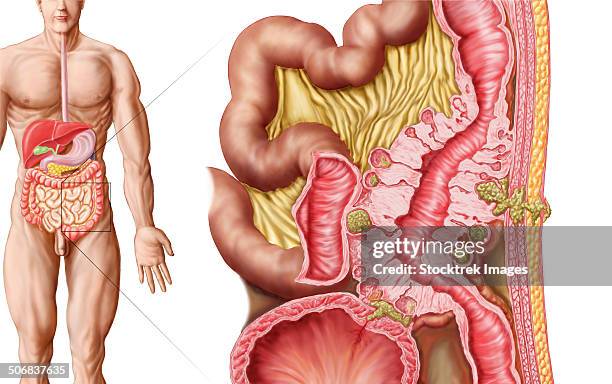 illustration of diverticulosis in the colon. - omentum stock illustrations