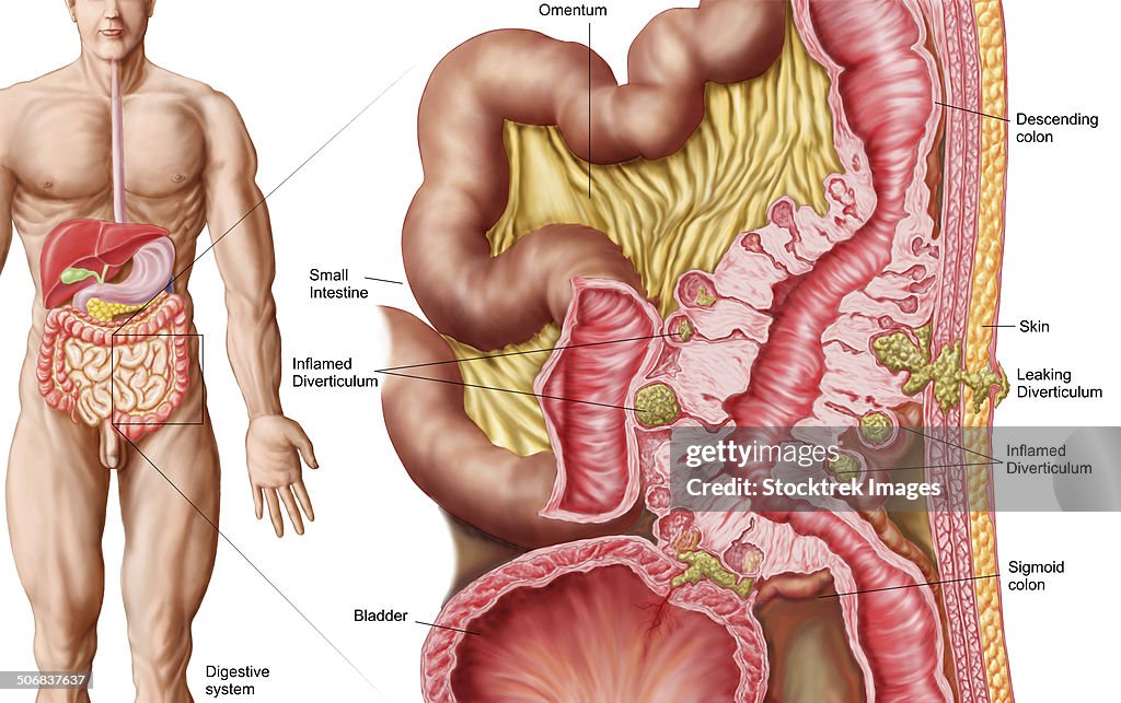 Illustration of diverticulosis in the colon.
