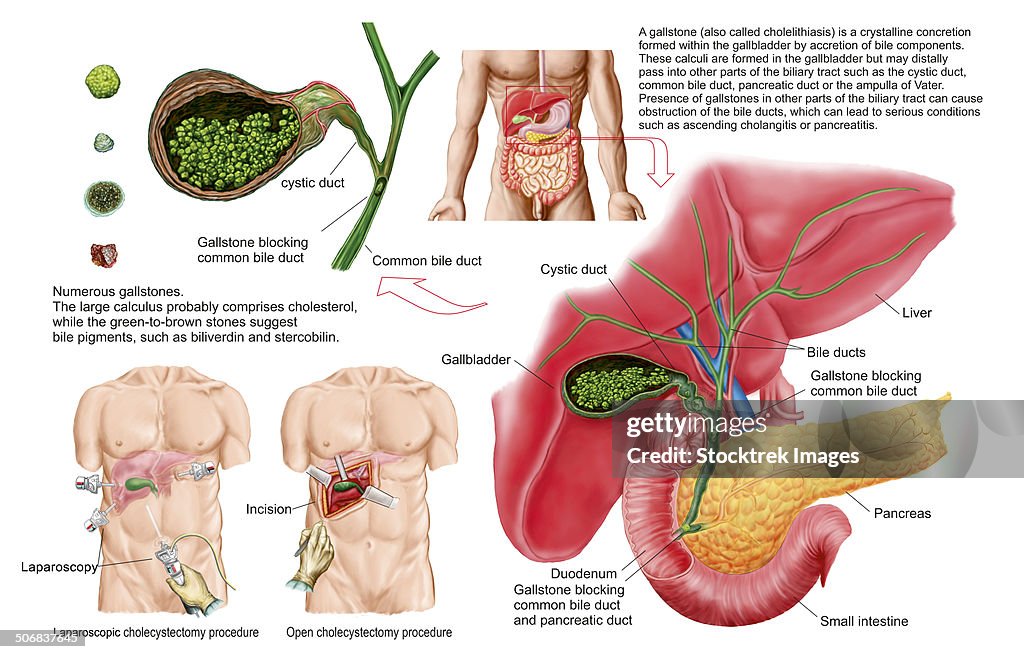 Medical ilustration showing gallstones in the gallbladder and the surgical removal of the gallbladder, known as cholecystectomy.