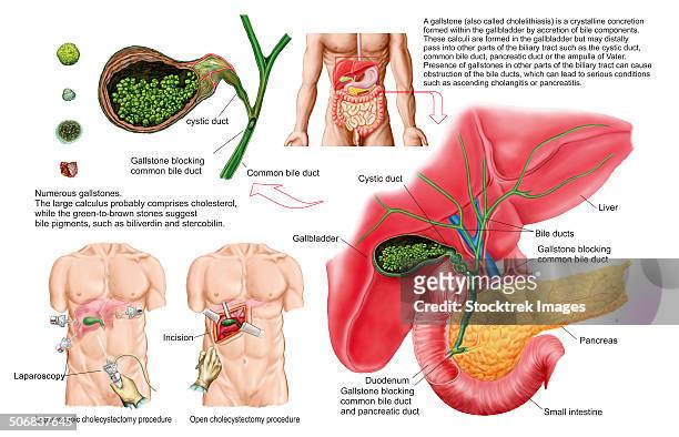 medical ilustration showing gallstones in the gallbladder and the surgical removal of the gallbladder, known as cholecystectomy. - mucus stock illustrations
