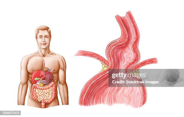 ilustraciones, imágenes clip art, dibujos animados e iconos de stock de medical ilustration of a hiatal hernia in the upper part of the stomach into the thorax. - hernia de hiato