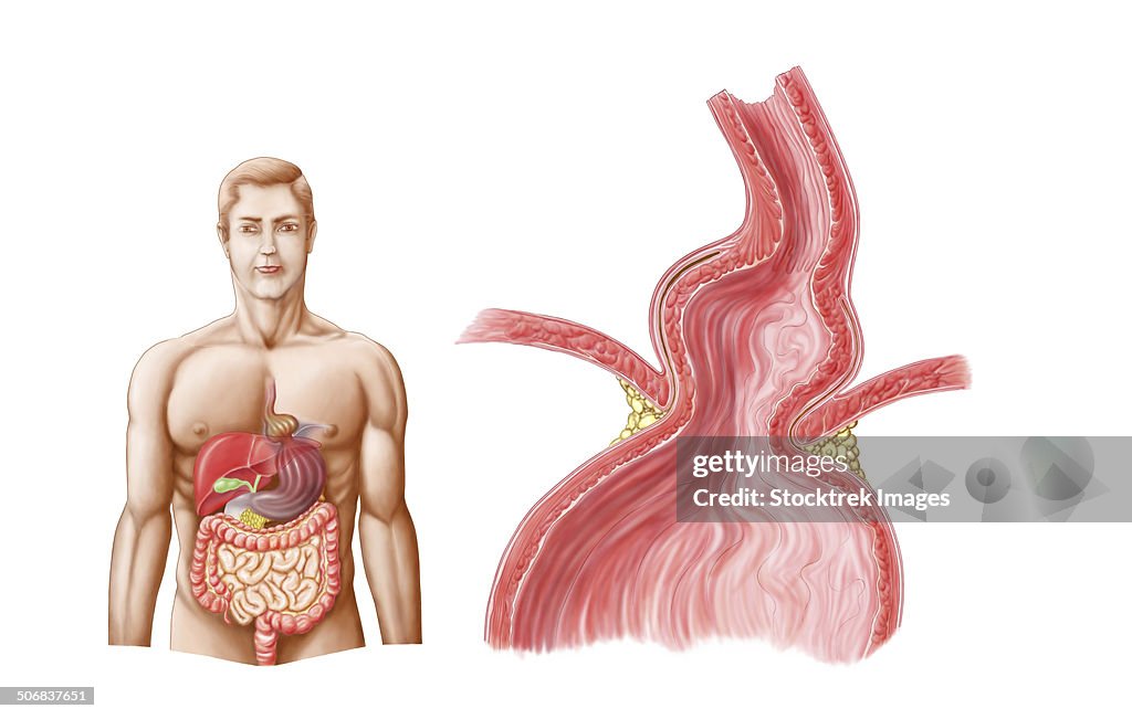 Medical ilustration of a hiatal hernia in the upper part of the stomach into the thorax.