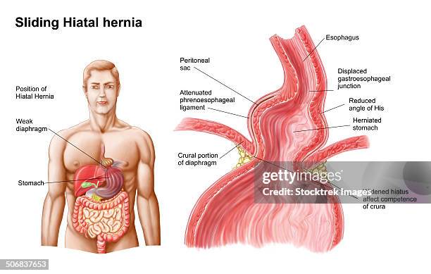 ilustraciones, imágenes clip art, dibujos animados e iconos de stock de medical ilustration of a hiatal hernia in the upper part of the stomach into the thorax. - hernia de hiato