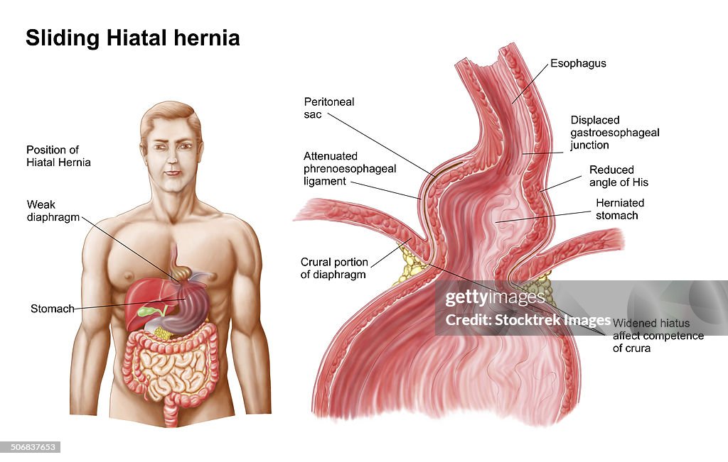 Medical ilustration of a hiatal hernia in the upper part of the stomach into the thorax.
