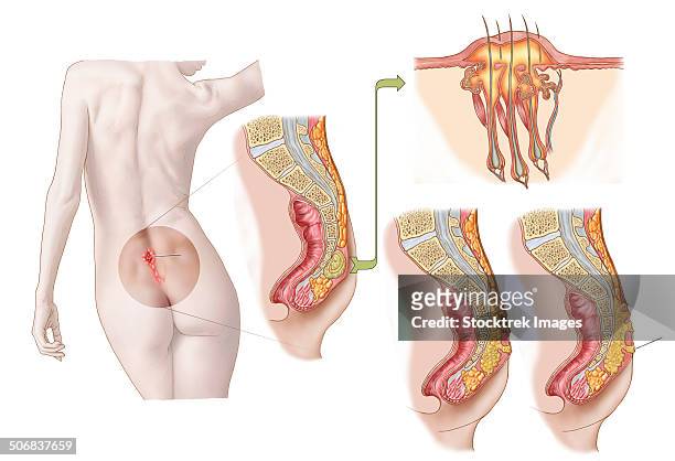 ilustrações, clipart, desenhos animados e ícones de medical ilustration of a pilonidal cyst near the natal cleft of the buttocks. - cyst