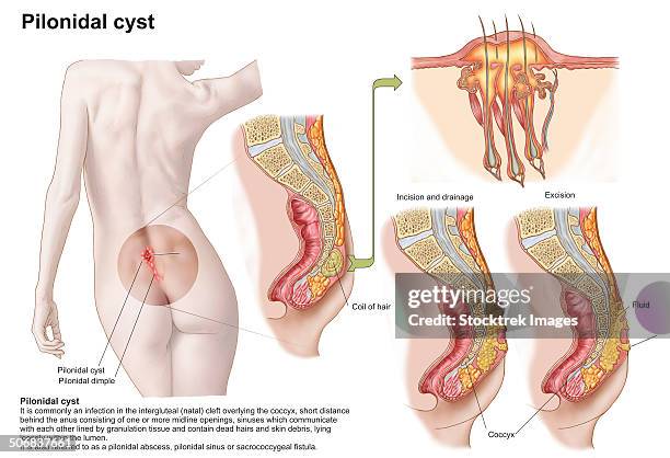 medical ilustration of a pilonidal cyst near the natal cleft of the buttocks. - cyst stock illustrations