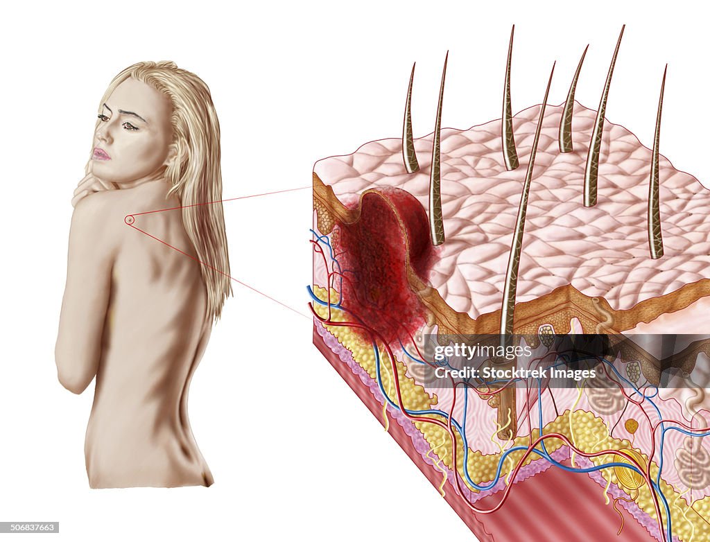 Illustration of an atypical growth on the skin that could be a sign of skin cancer.