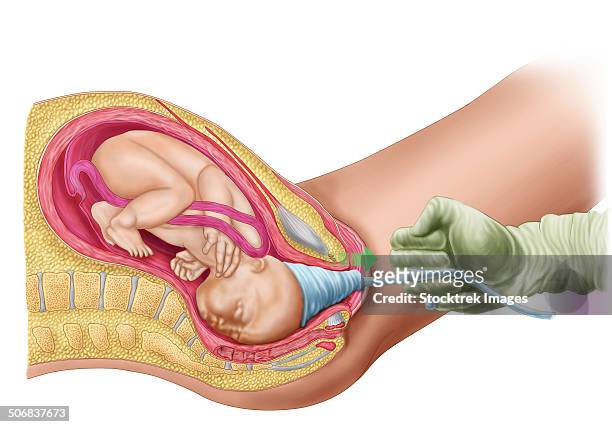 illustration showing delivery of fetus using vacuum extraction. - schambeinfuge stock-grafiken, -clipart, -cartoons und -symbole