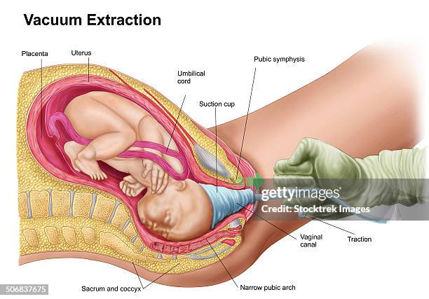 illustration showing delivery of fetus using vacuum extraction. - schambeinfuge stock-grafiken, -clipart, -cartoons und -symbole