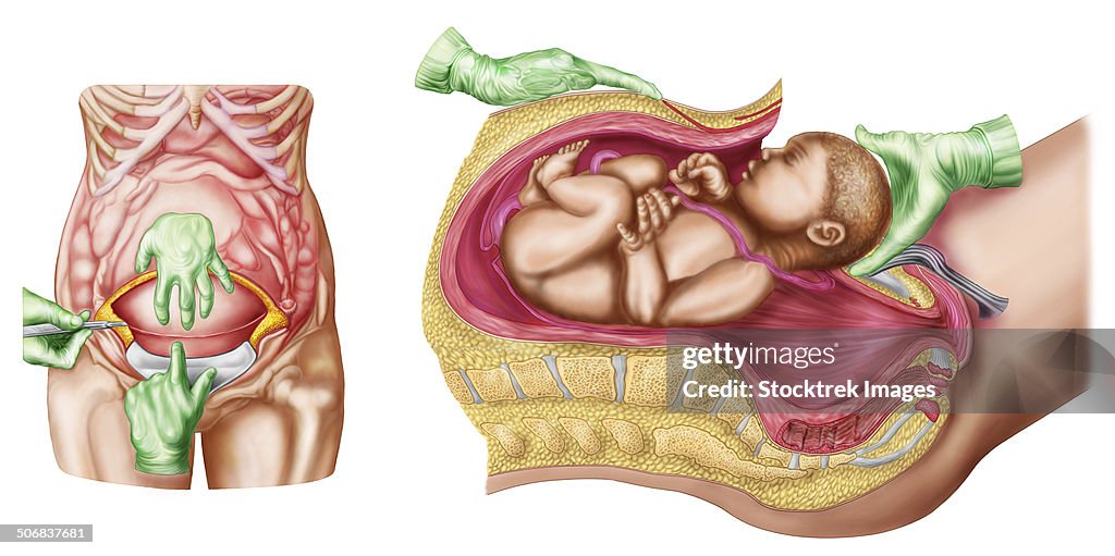 Illustration showing Caesarean delivery of fetus.
