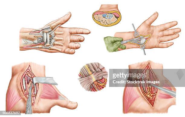 medical illustration showing carpal tunnel syndrome in the human wrist, and the surgical procedures associated with it. - neuropathy stock-grafiken, -clipart, -cartoons und -symbole