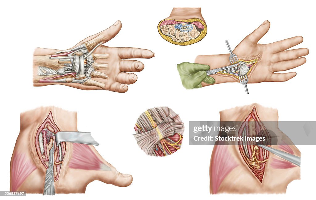 Medical illustration showing carpal tunnel syndrome in the human wrist, and the surgical procedures associated with it.