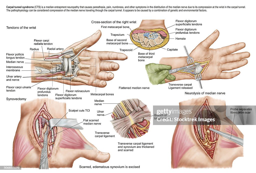 Medical illustration showing carpal tunnel syndrome in the human wrist, and the surgical procedures associated with it.