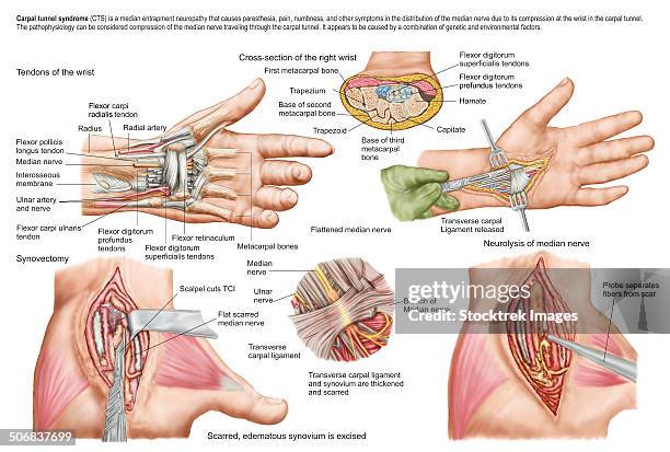 ilustrações de stock, clip art, desenhos animados e ícones de medical illustration showing carpal tunnel syndrome in the human wrist, and the surgical procedures associated with it. - carpal tunnel syndrome