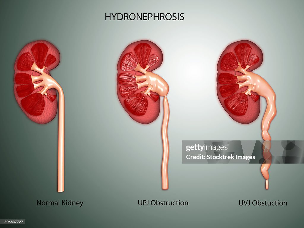 Hydronephrosis condition of the kidney.