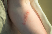 Injury from a burn jellyfish on a female hand