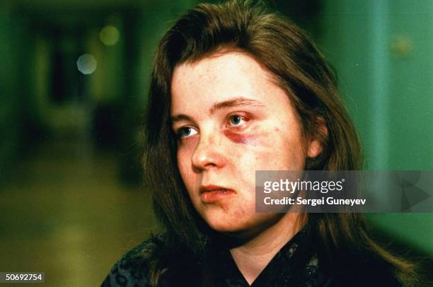 Olga, woman beaten by her husband, inflicting black eye & facial bruises, seeking treatment 2 days after assualt at Hospital 36.