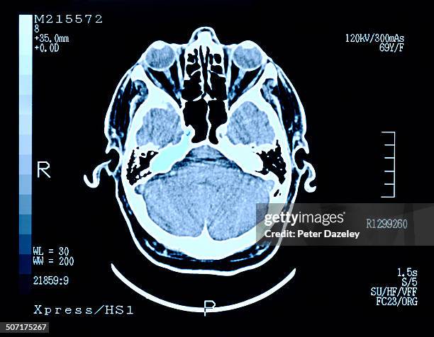 brain scan - magnetresonanztomographie stock-fotos und bilder