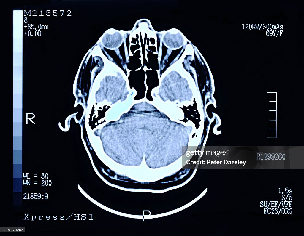 Brain scan