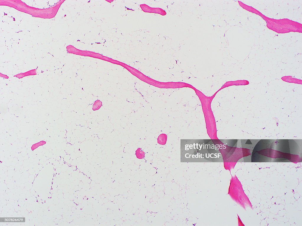 H&E stain, light microscopy, osteoporosis, bone