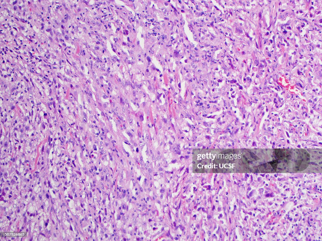 H&E stain, light microscopy, malignant melanoma of skin