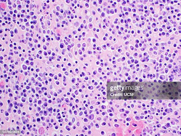 h&e stain, light microscopy, multiple myeloma - menschliche zelle stock-fotos und bilder