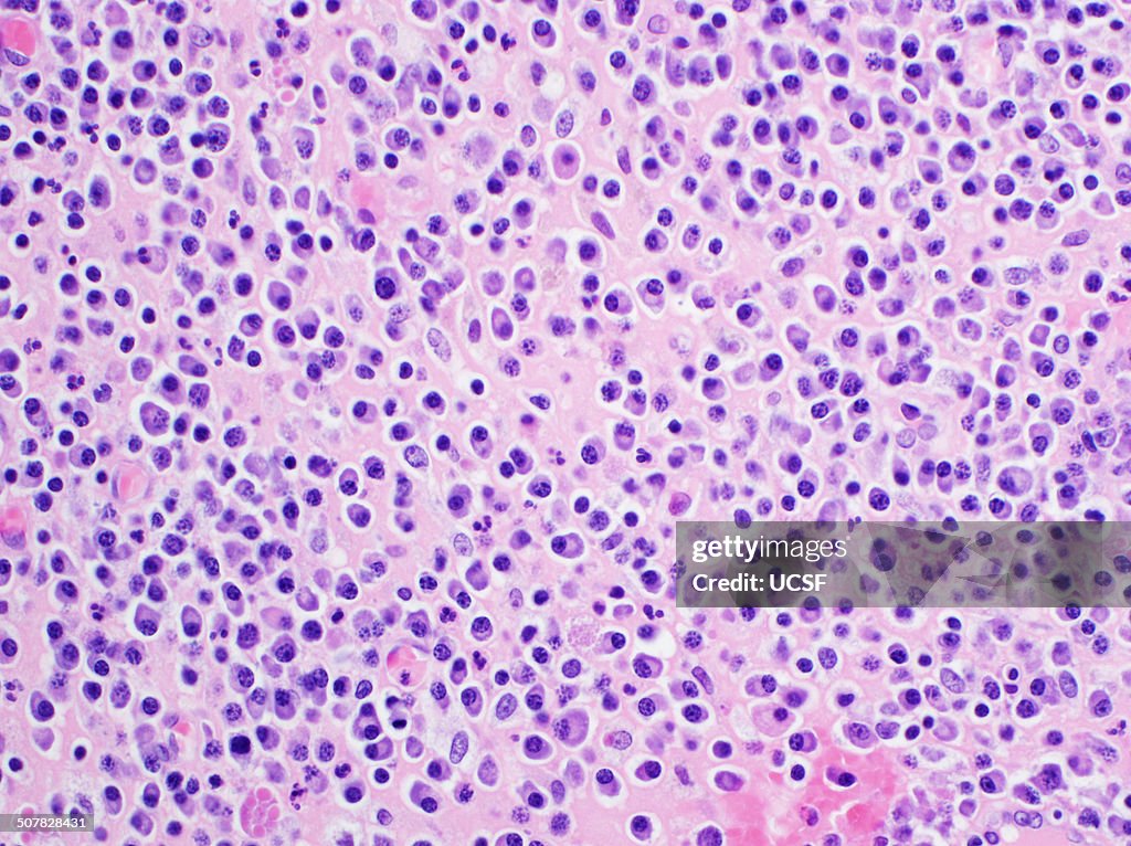 H&E stain, light microscopy, multiple myeloma