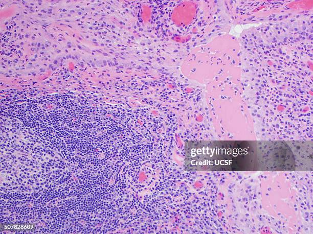 h&e stain, light microscopy, rheumatoid arthritis of joint showing pannus - rheuma stock-fotos und bilder