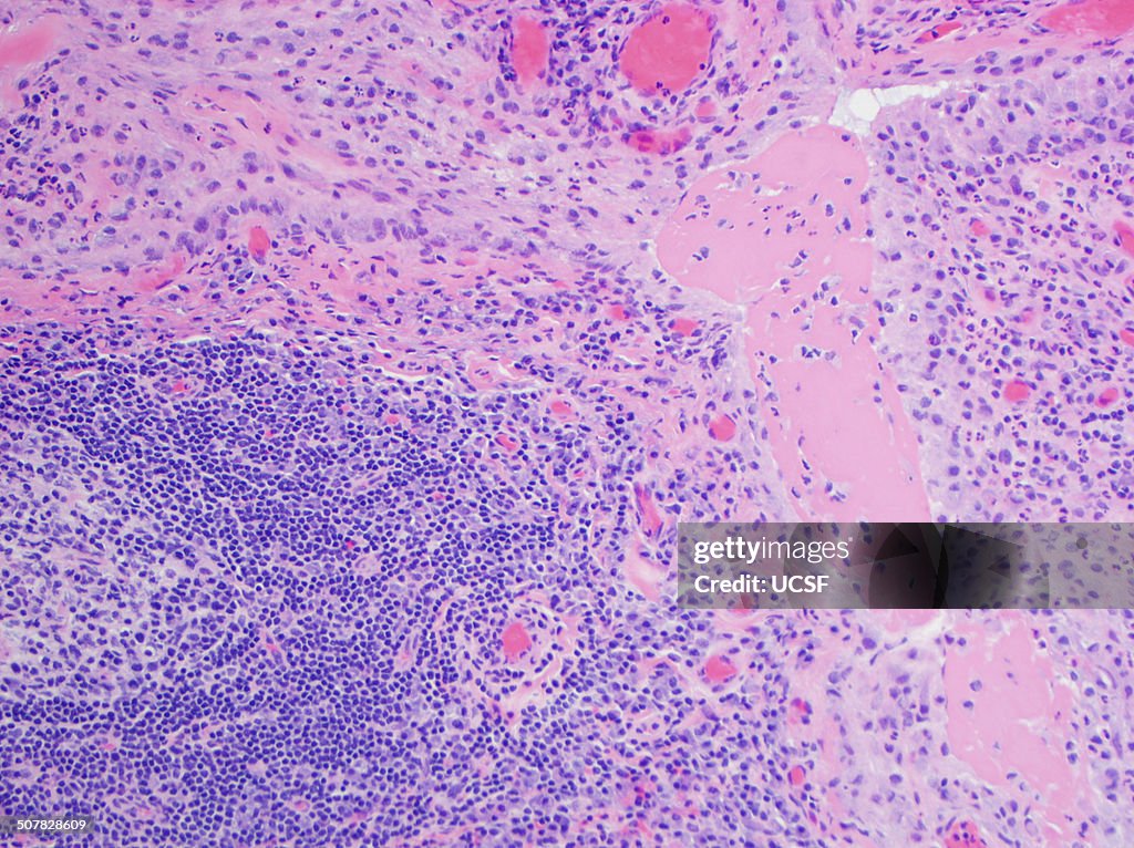 H&E stain, light microscopy, rheumatoid arthritis of joint showing pannus