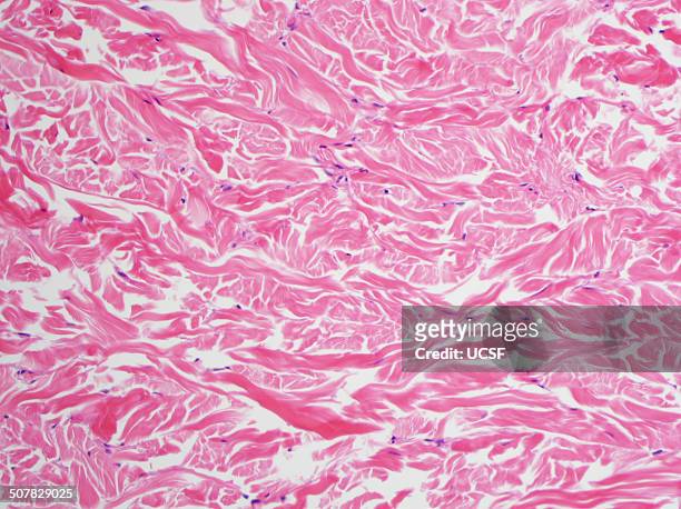 h&e stain, light microscopy, abundant collagen in a gardner fibroma - hematoxylin and eosin staining stockfoto's en -beelden