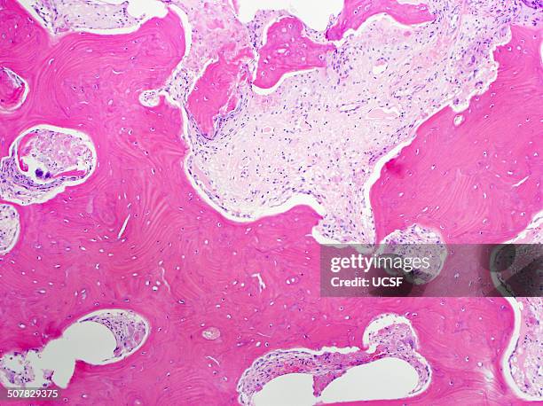 h&e stain, light microscopy, paget disease of bone - ヘマトキシリンエオジン染色 ストックフォトと画像