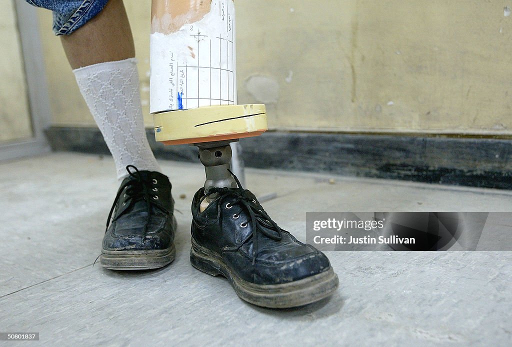 Baghdad Hospital Makes Artificial Limbs For Injured Iraqis