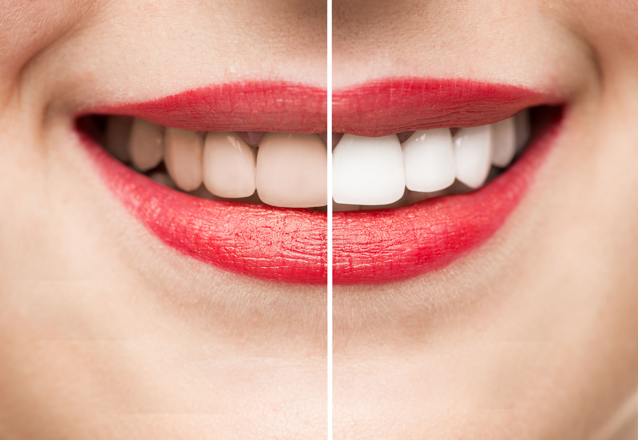 smile makeover