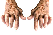 Rheumatoid Arthritis Isolated on White Background