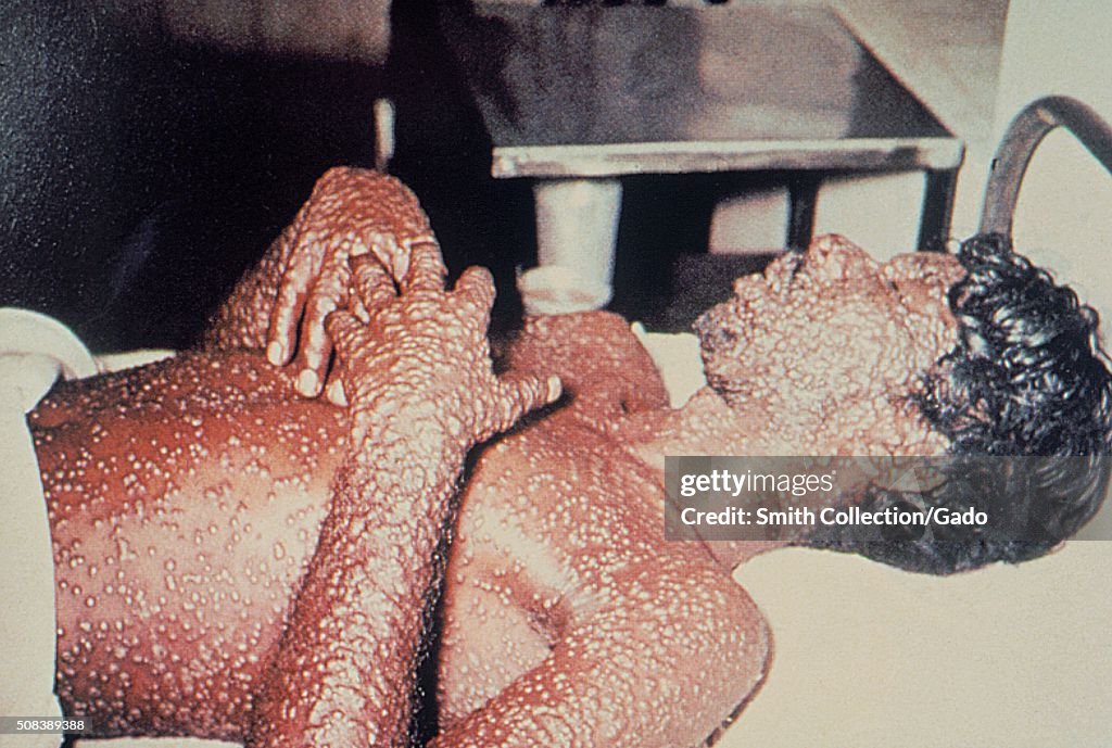 Smallpox, Man With Smallpox