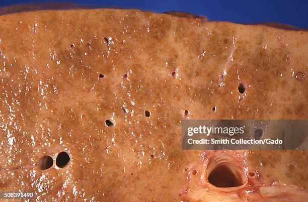 Alcoholic cirrhosis, liver. This cut surface of a gross autopsy specimen of the liver showed diffuse pallor due to a dense network of scar tissue,...