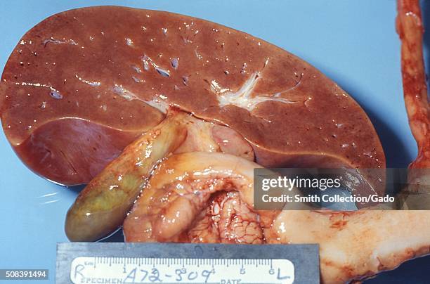 Gross pathology of liver in fatal Reye's syndrome, The cut surface of this gross autopsy specimen of a liver from a child who died of Reye's...