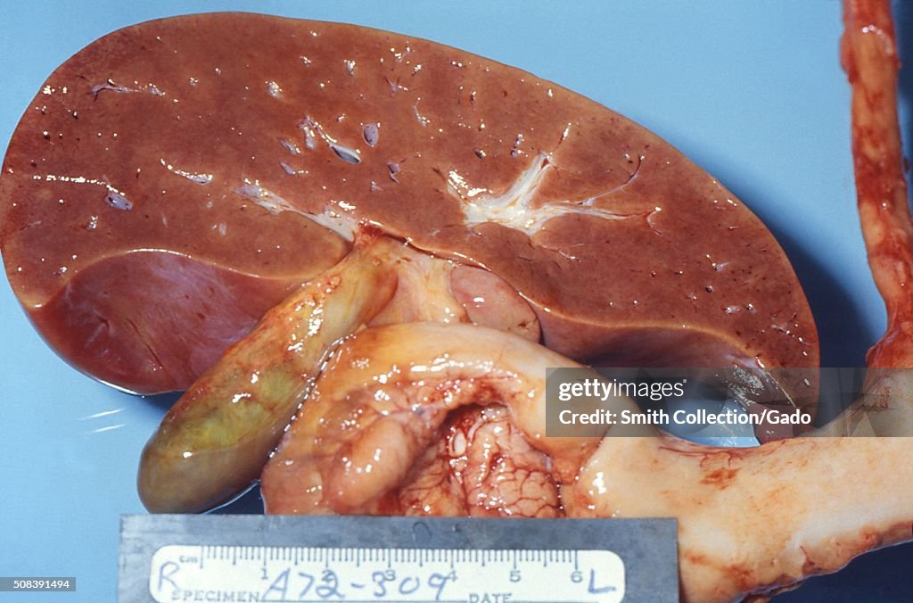 Reye's syndrome