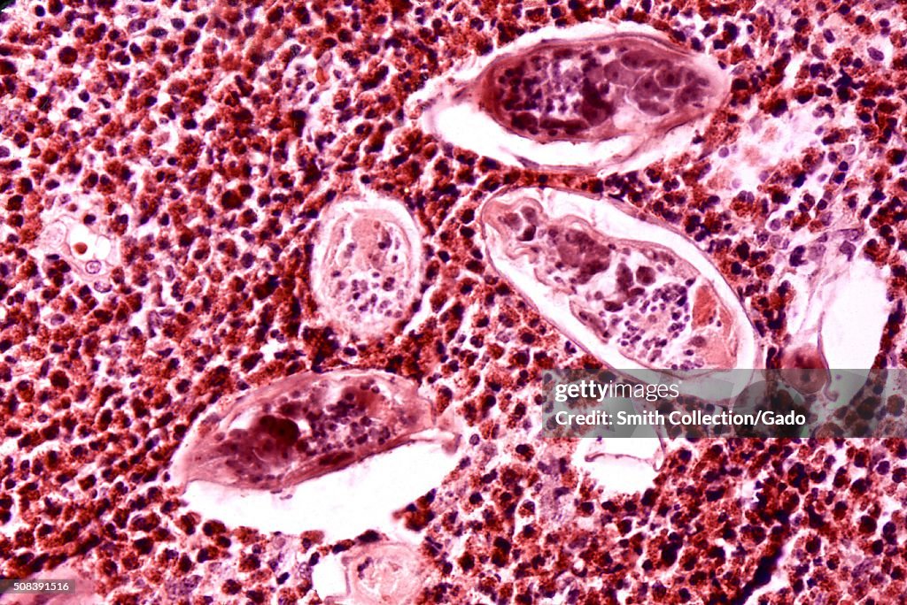 Schistosomiasis haematobia