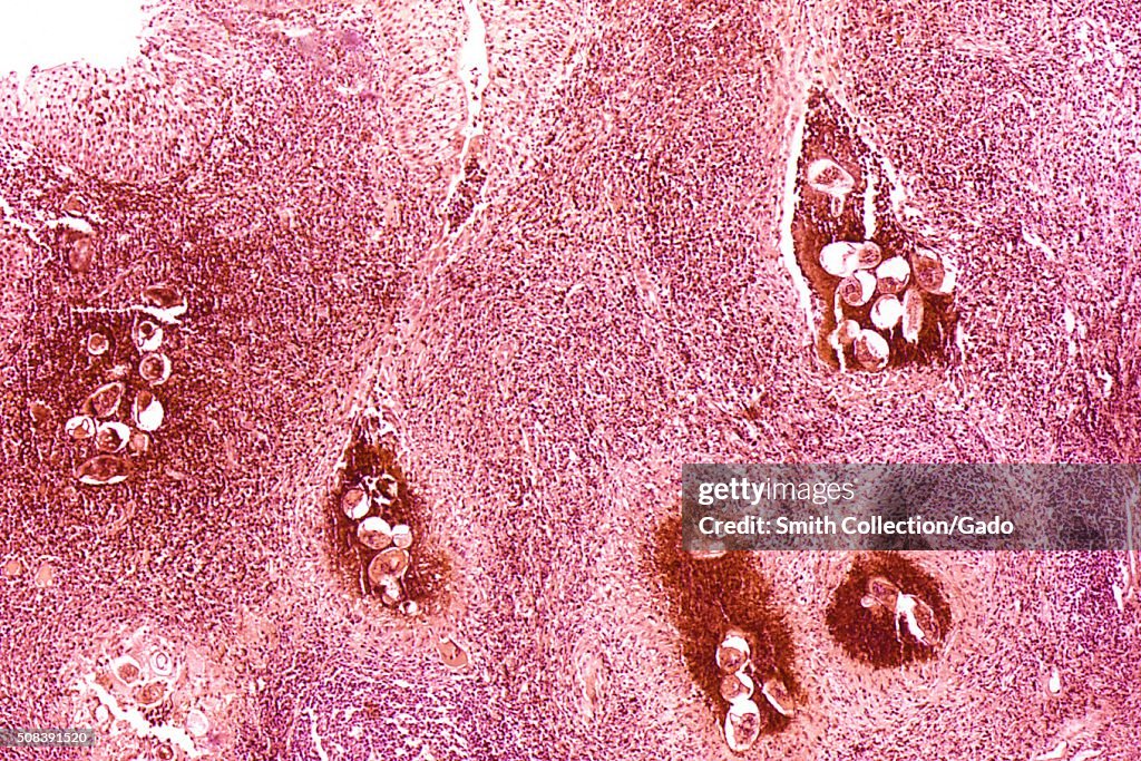 Schistosomiasis haematobia