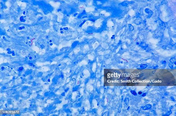 Histopathology of tuberculosis, placenta, Histopathology of placenta thrombus with inflammatory cells and acid-fast bacilli of Mycobacterium...